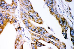 Anti- Claudin 2 antibody, IHC(P) IHC(P): Human Intestinal Cancer Tissue (Claudin 2 anticorps  (AA 38-230))