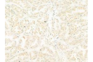 ABIN6265702 and ABIN6268943 at 1/100 staining human colon carcinoma by IHC-P. (TRAF1 anticorps  (C-Term))