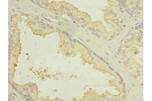Immunohistochemistry of paraffin-embedded human prostate cancer using ABIN7164401 at dilution of 1:100 (SLC7A14 anticorps  (AA 676-771))