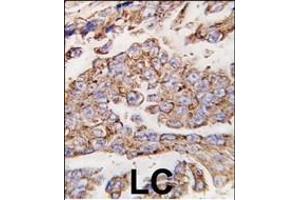 Formalin-fixed and paraffin-embedded human lung carcinoma tissue reacted with *LP1 antibody (N-term) (ABIN388566 and ABIN2849737) , which was peroxidase-conjugated to the secondary antibody, followed by DAB staining. (LAMP1 anticorps  (N-Term))