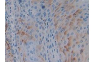 Detection of PTPRH in Human Skin cancer Tissue using Polyclonal Antibody to Protein Tyrosine Phosphatase Receptor Type H (PTPRH) (PTPRH anticorps  (AA 844-1096))