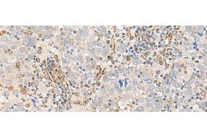 Immunohistochemistry of paraffin-embedded Human cervical cancer tissue using FECH Polyclonal Antibody at dilution of 1:55(x200)