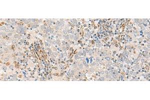 Immunohistochemistry of paraffin-embedded Human cervical cancer tissue using FECH Polyclonal Antibody at dilution of 1:55(x200) (FECH anticorps)