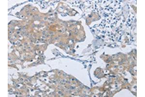 The image on the left is immunohistochemistry of paraffin-embedded Human breast cancer tissue using ABIN7189583(ABCB9 Antibody) at dilution 1/15, on the right is treated with synthetic peptide. (ABCB9 anticorps)