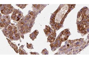 ABIN6277215 at 1/100 staining Human liver cancer tissue by IHC-P.