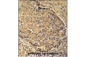 IGSF1 antibody (C-term) (ABIN654689 and ABIN2844381) immunohistochemistry analysis in formalin fixed and paraffin embedded human prostate carcinoma followed by peroxidase conjugation of the secondary antibody and DAB staining. (IGSF1 anticorps  (C-Term))