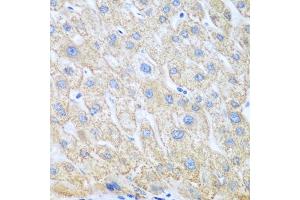Immunohistochemistry of paraffin-embedded human liver cancer using COX1/COX1/PTGS1 antibody (ABIN6130124, ABIN6146413, ABIN6146414 and ABIN6223187) at dilution of 1:100 (40x lens). (PTGS1 anticorps  (AA 1-180))