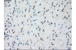 Immunohistochemical staining of paraffin-embedded Adenocarcinoma of colon tissue using anti-BUB1Bmouse monoclonal antibody. (BUB1B anticorps)