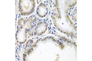 Immunohistochemistry of paraffin-embedded human colon carcinoma using SSX2 antibody (ABIN5974203) at dilution of 1/200 (40x lens). (SSX2 anticorps)