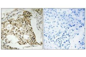 Immunohistochemistry analysis of paraffin-embedded human breast carcinoma tissue using Retinoic Acid Receptor α (Phospho-Ser77) antibody.