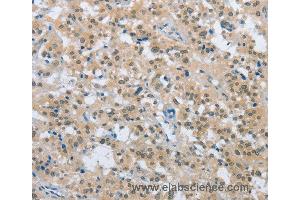 Immunohistochemistry of Human thyroid cancer using ENTPD5 Polyclonal Antibody at dilution of 1:20 (ENTPD5 anticorps)