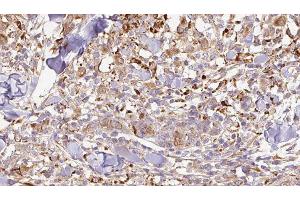 ABIN6276952 at 1/100 staining Human Melanoma tissue by IHC-P. (CNTF anticorps  (C-Term))