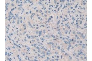 Detection of PDHX in Human Prostate cancer Tissue using Polyclonal Antibody to Pyruvate Dehydrogenase Complex Component X (PDHX) (PDHX anticorps  (AA 220-468))