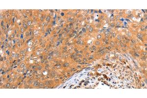 Immunohistochemistry of paraffin-embedded Human cervical cancer tissue using ACOX3 Polyclonal Antibody at dilution 1:35 (ACOX3 anticorps)