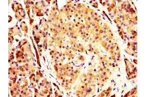 IHC image of ABIN7146715 diluted at 1:400 and staining in paraffin-embedded human pancreatic cancer performed on a Leica BondTM system.