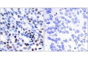 Immunohistochemistry analysis of paraffin-embedded human breast carcinoma tissue, using JunB (Ab-259) Antibody.