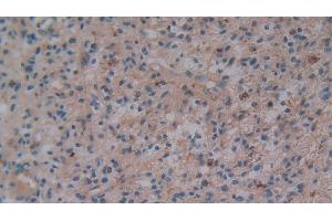 Detection of OPN in Human Glioma Tissue using Polyclonal Antibody to Osteopontin (OPN)