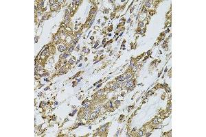 Immunohistochemistry of paraffin-embedded human gastric cancer using PIK3CA antibody.