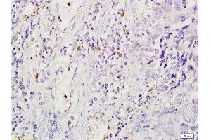 Formalin-fixed and paraffin embedded human esophageal cancer labeled with Anti-MSR1/CD204 Polyclonal Antibody, Unconjugated  at 1:200, followed by conjugation to the secondary antibody and DAB staining