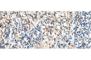 Immunohistochemistry of paraffin-embedded Human lung cancer tissue using DHRSX Polyclonal Antibody at dilution of 1:30(x200) (DHRSX anticorps)