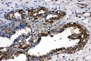 LDHA was detected in paraffin-embedded sections of human mammary cancer tissues using rabbit anti- LDHA Antigen Affinity purified polyclonal antibody (Catalog # ) at 1 µg/mL.