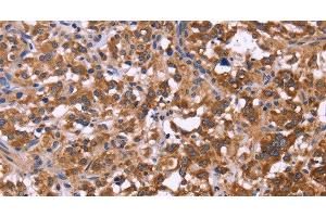Immunohistochemistry of paraffin-embedded Human thyroid cancer tissue using FBXW7 Polyclonal Antibody at dilution 1:40 (FBXW7 anticorps)