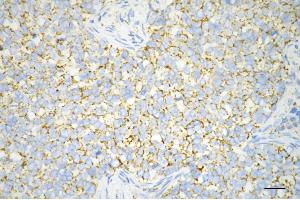 Immunohistochemistry was performed on paraffin-embedded human breast carcinoma using C1QBP antibody (ABIN7798136), 1:200). (Recombinant C1QBP anticorps)