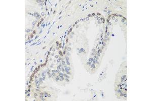 Immunohistochemistry of paraffin-embedded human prostate using MDC1 antibody (ABIN5974564) at dilution of 1/100 (40x lens). (MDC1 anticorps)