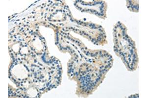 The image on the left is immunohistochemistry of paraffin-embedded Human thyroid cancer tissue using ABIN7193059(WNT10A Antibody) at dilution 1/30, on the right is treated with synthetic peptide.