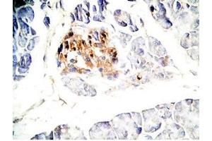 Human pancreas cancer tissue was stained by Rabbit Anti-GLP-1(7-36) -NH2 Antibody