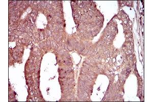 Immunohistochemical analysis of paraffin-embedded rectum cancer tissues using CD93 mouse mAb with DAB staining. (CD93 anticorps  (AA 474-535))