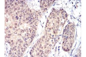 Immunohistochemical analysis of paraffin-embedded bladder cancer tissues using RAD23A mouse mAb with DAB staining. (RAD23A anticorps  (AA 1-363))