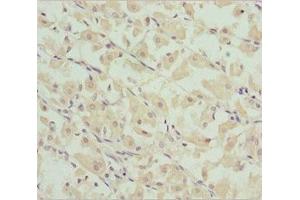Immunohistochemistry of paraffin-embedded human gastric cancer using ABIN7149046 at dilution of 1:100 (CHIC2 anticorps  (AA 1-165))