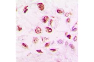 Immunohistochemical analysis of Histone Deacetylase 9 staining in human lung cancer formalin fixed paraffin embedded tissue section.