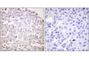 Immunohistochemistry analysis of paraffin-embedded human breast carcinoma tissue, using GADD153 Antibody.