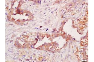 Formalin-fixed and paraffin embedded human lung carcinoma labeled with Anti-Polyclonal Antibody, Unconjugated 1:200 followed by conjugation to the secondary antibody and DAB staining (CD21 anticorps  (AA 981-1092))