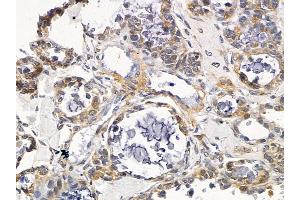 ABIN6258471 and ABIN6275673 at 1/100 staining human ovarian cancer by IHC-P.