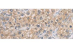 Immunohistochemistry of paraffin-embedded Human liver cancer tissue using GAB4 Polyclonal Antibody at dilution of 1:60(x200) (GAB4 anticorps)