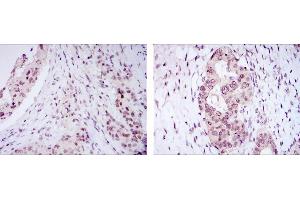 Immunohistochemical analysis of paraffin-embedded mammary cancer tissues (left) and ovarian cancer tissues (right) using NACC1 mouse mAb with DAB staining. (NAC1 anticorps)