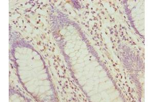 Immunohistochemistry of paraffin-embedded human colon cancer using ABIN7155961 at dilution of 1:100 (HABP2 anticorps  (AA 314-560))