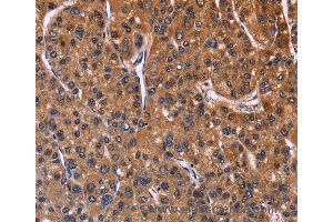 Immunohistochemistry of Human colon cancer using NFATC3 Polyclonal Antibody at dilution of 1:60 (NFATC3 anticorps)