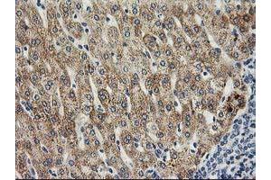 Immunohistochemical staining of paraffin-embedded Human liver tissue using anti-SOCS3 mouse monoclonal antibody. (SOCS3 anticorps)