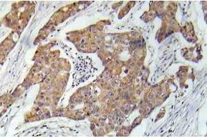 Immunohistochemistry (IHC) analyzes of VEGFR2 pAb in paraffin-embedded human prostate carcinoma tissue. (VEGFR2/CD309 anticorps)