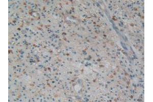 IHC-P analysis of Human Prostate Gland Cancer Tissue, with DAB staining. (Gelsolin anticorps  (AA 577-771))