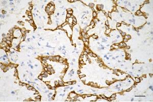 Immunohistochemistry was performed on paraffin-embedded human lung adenocarcinoma using keratin 7 antibody (ABIN7799186), 1:200). (Recombinant Cytokeratin 7 anticorps)