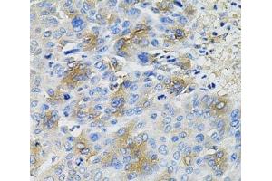 Immunohistochemistry of paraffin-embedded Human liver cancer using SERPINA1 Polyclonal Antibody at dilution of 1:100 (40x lens). (SERPINA1 anticorps)