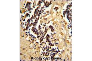 Formalin-fixed and paraffin-embedded human kidney carcinoma reacted with EHD3 Antibody , which was peroxidase-conjugated to the secondary antibody, followed by DAB staining.