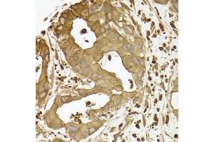 Immunohistochemistry of paraffin-embedded human liver cancer using ACTR2 antibody. (ACTR2 anticorps  (AA 1-160))