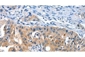 Immunohistochemistry of paraffin-embedded Human lung cancer tissue using AMHR2 Polyclonal Antibody at dilution 1:40 (AMHR2 anticorps)