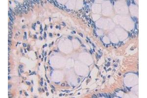 DAB staining on IHC-P; Samples: Human Colorectal cancer Tissue (ZBP1 anticorps  (AA 10-167))